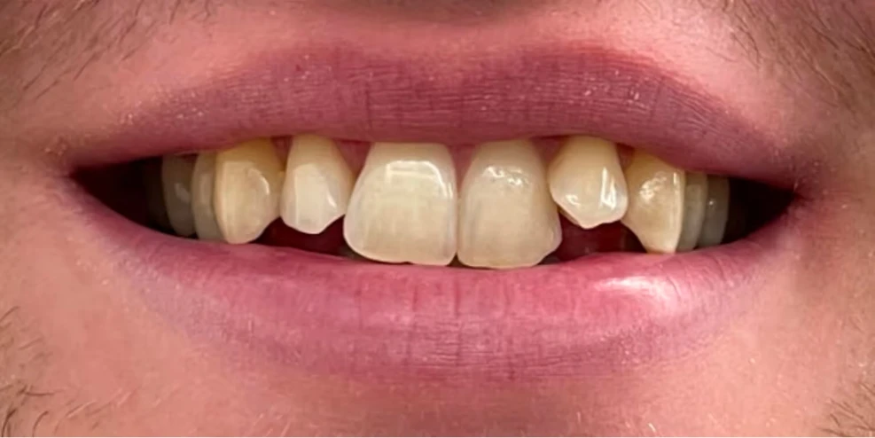Risultato prima e dopo un trattamento estetico dentale