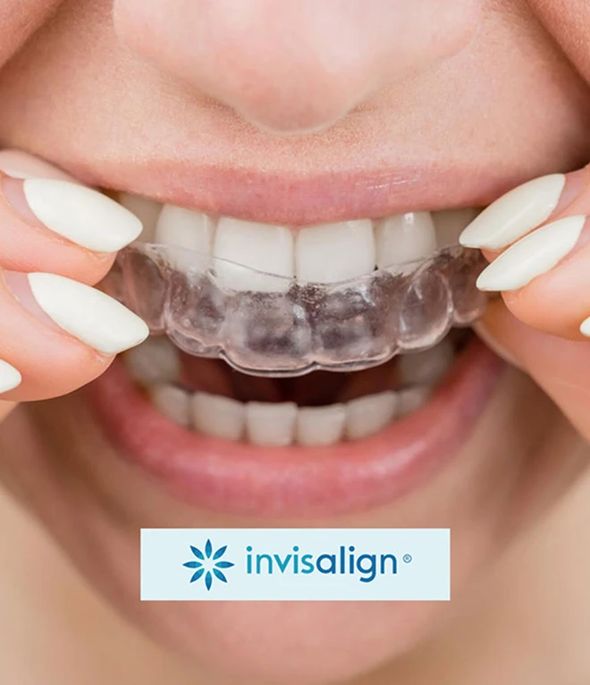 Close-up of a clear dental aligner (Invisalign)