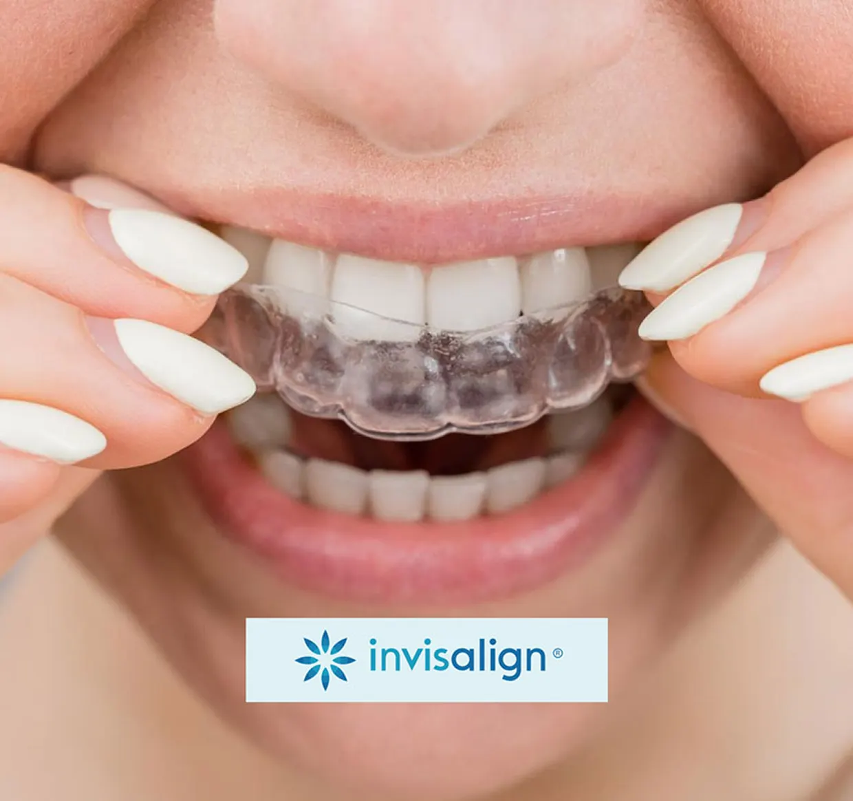 Trattamento con apparecchio dentale trasparente