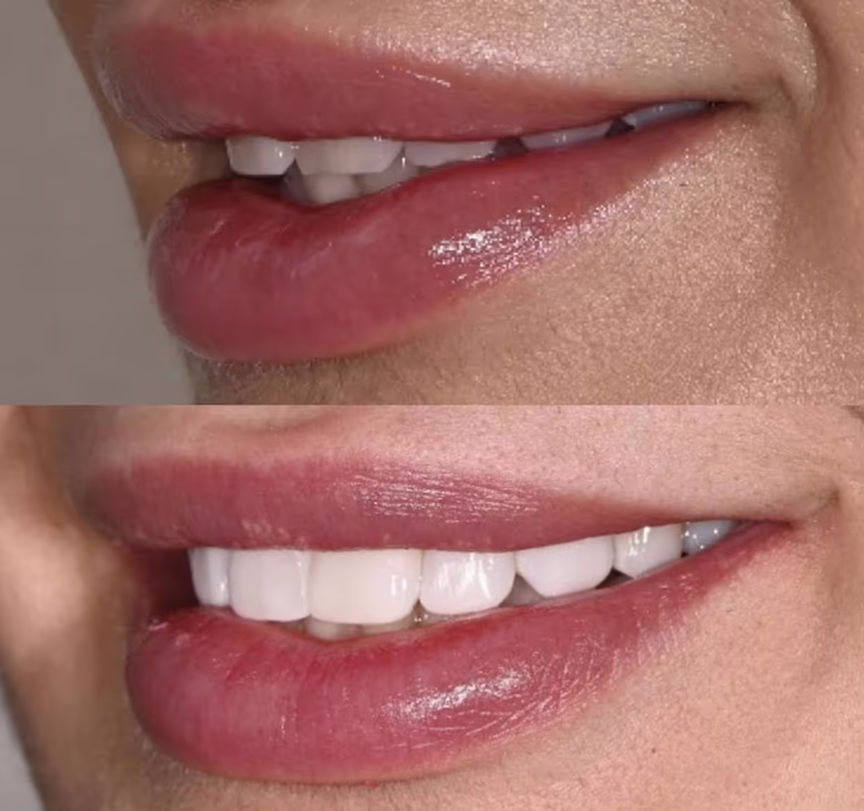 Prima e dopo del trattamento estetico delle labbra e del sorriso