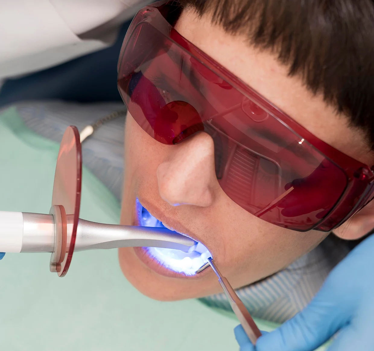 Otturazione composita del colore del dente