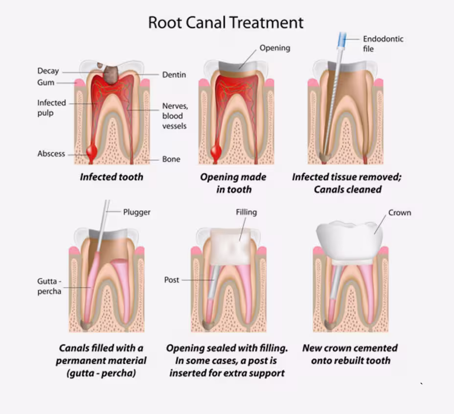 Illustrazione del trattamento canalare del dente