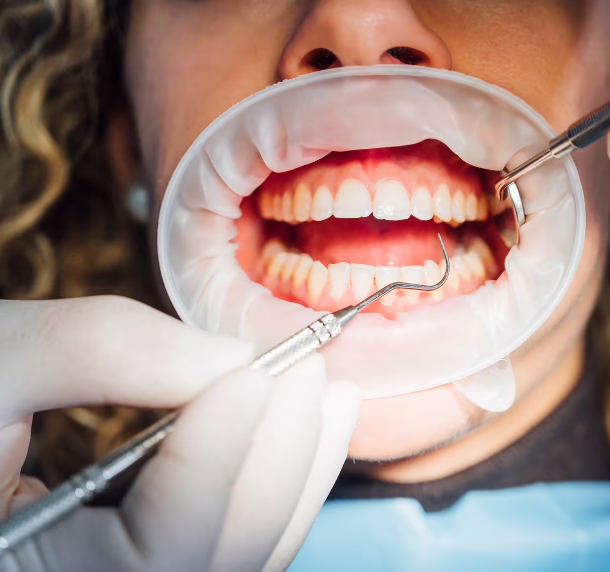Trattamento dentale preventivo per la salute orale