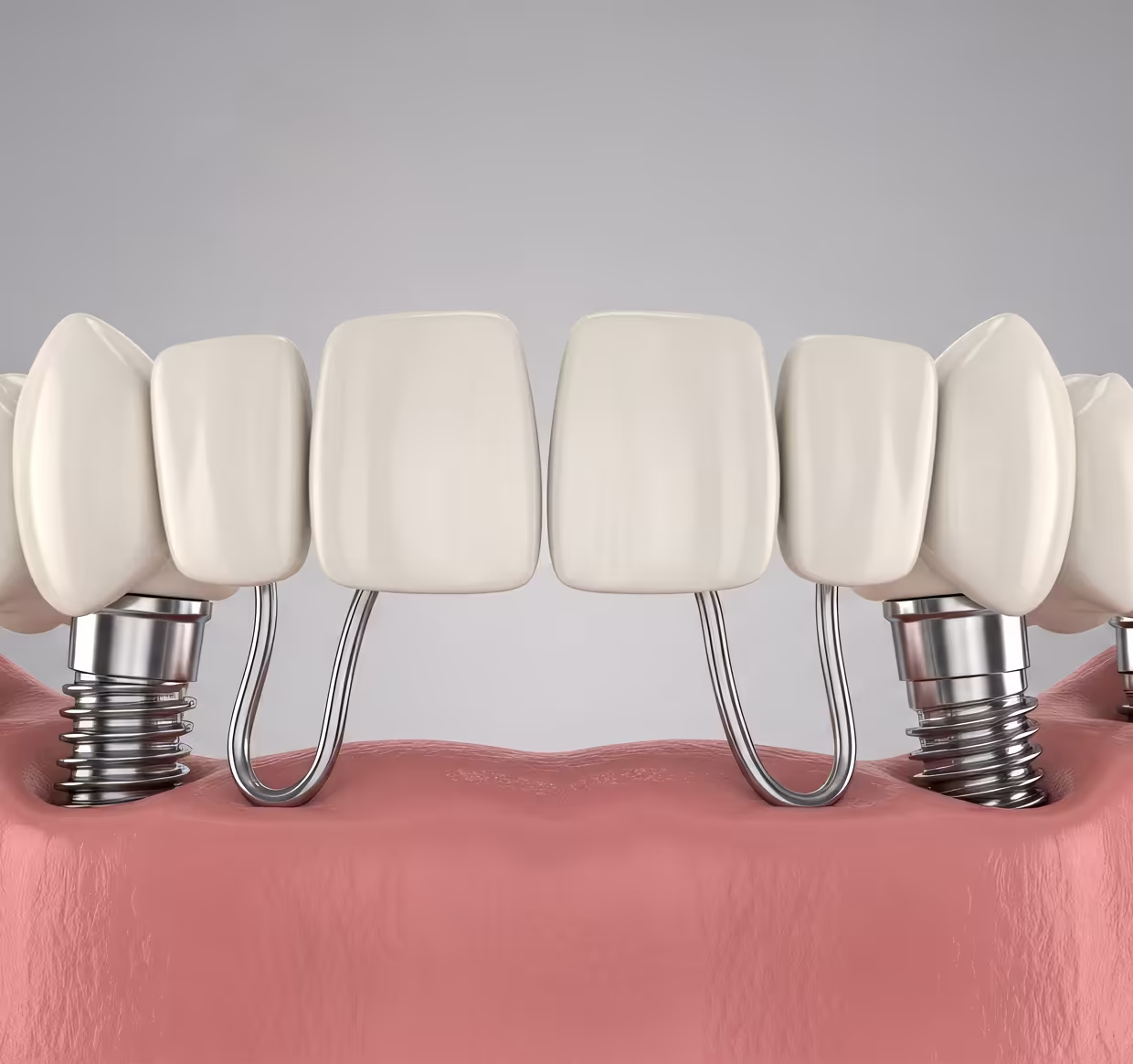 Faccette, corone e ponti dentali in studio