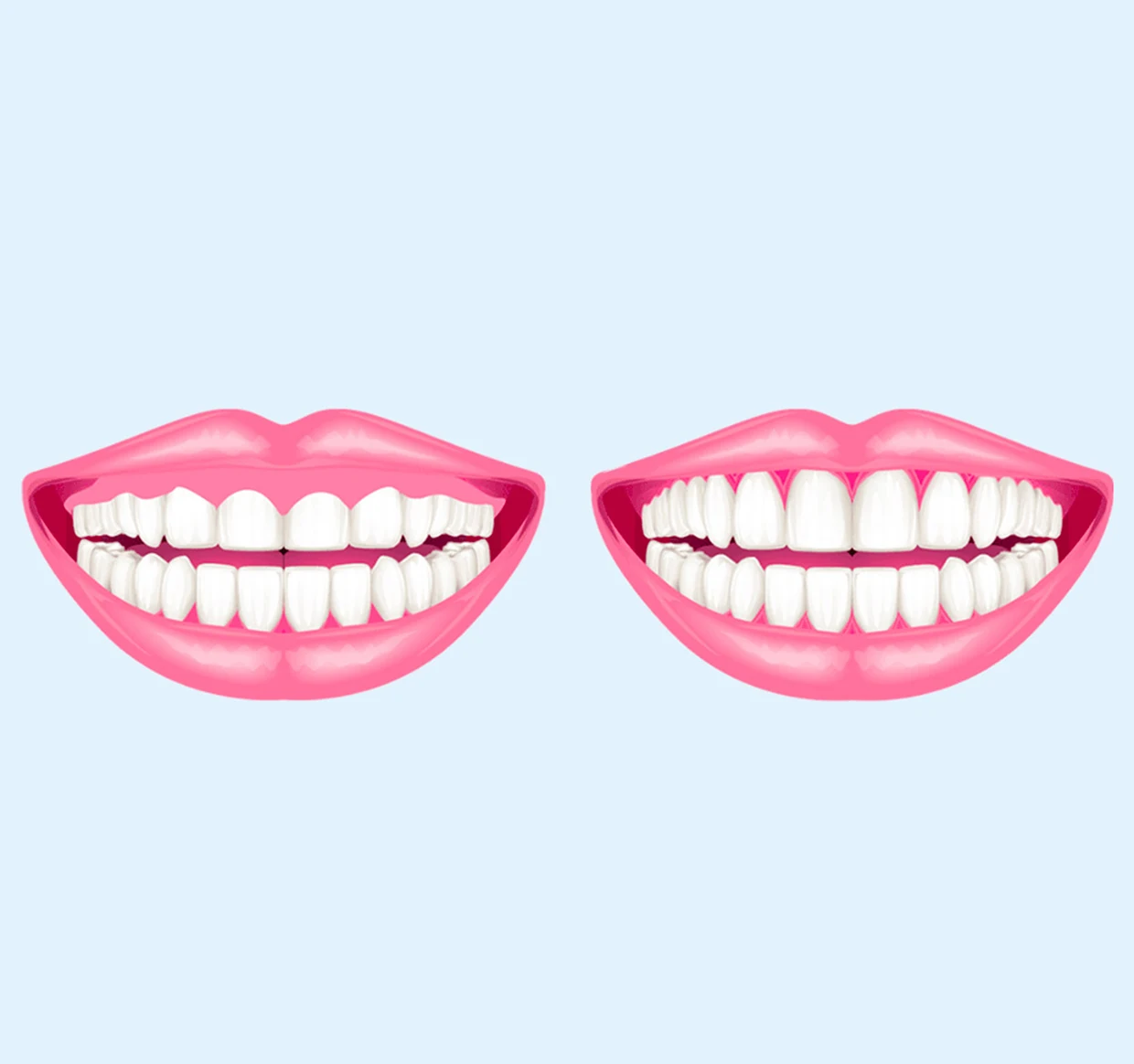 Confronto sorriso prima e dopo trattamento dentale