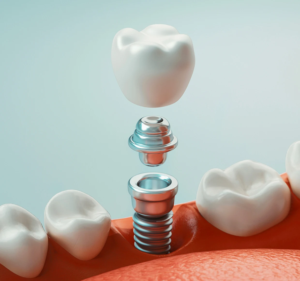 Impianto dentale con corona artificiale
