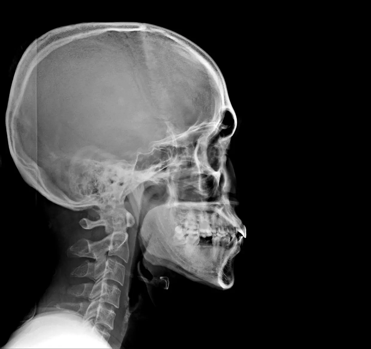 Radiografia del cranio e della mascella