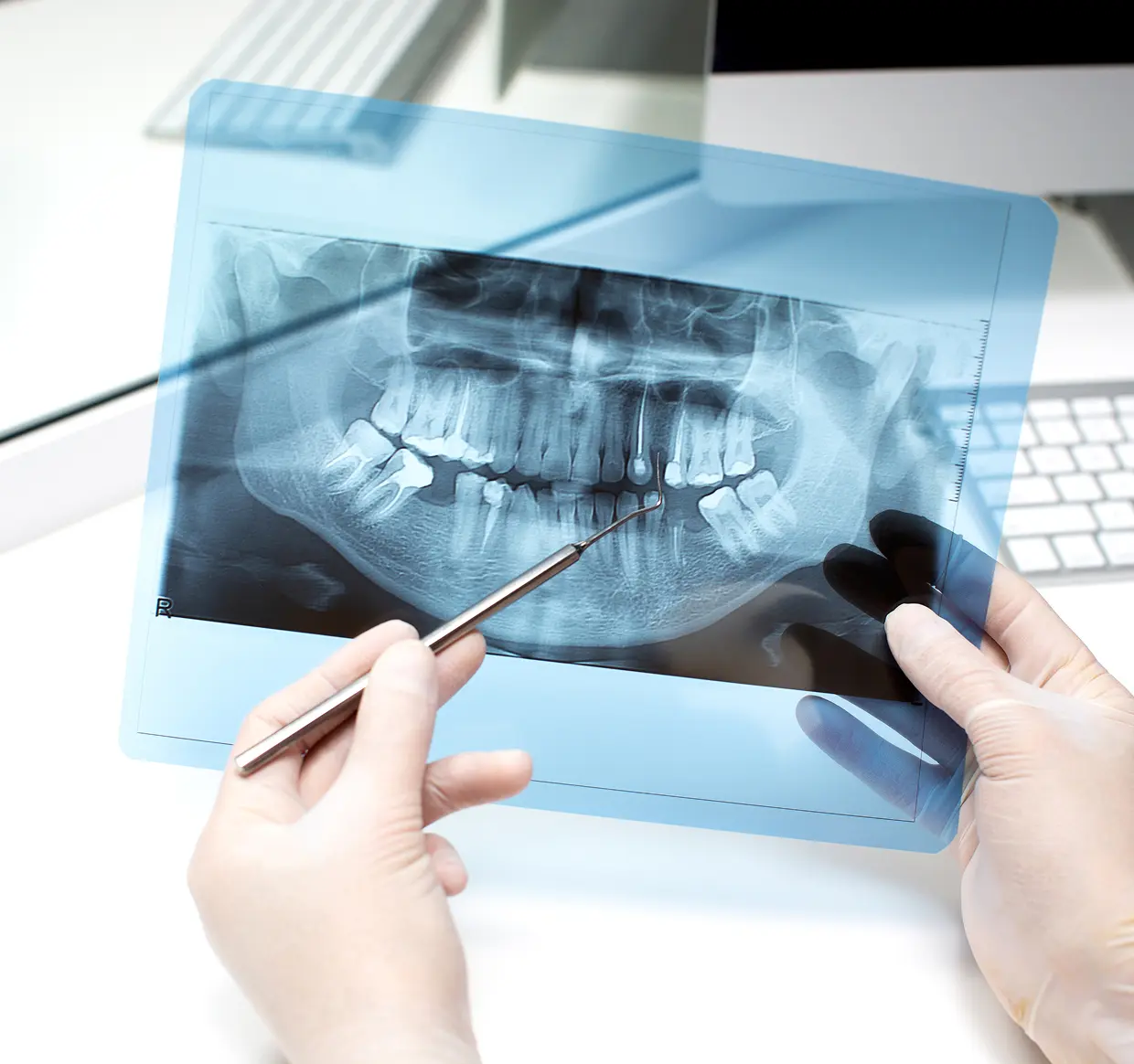 Radiografia dentale analizzata dal dentista