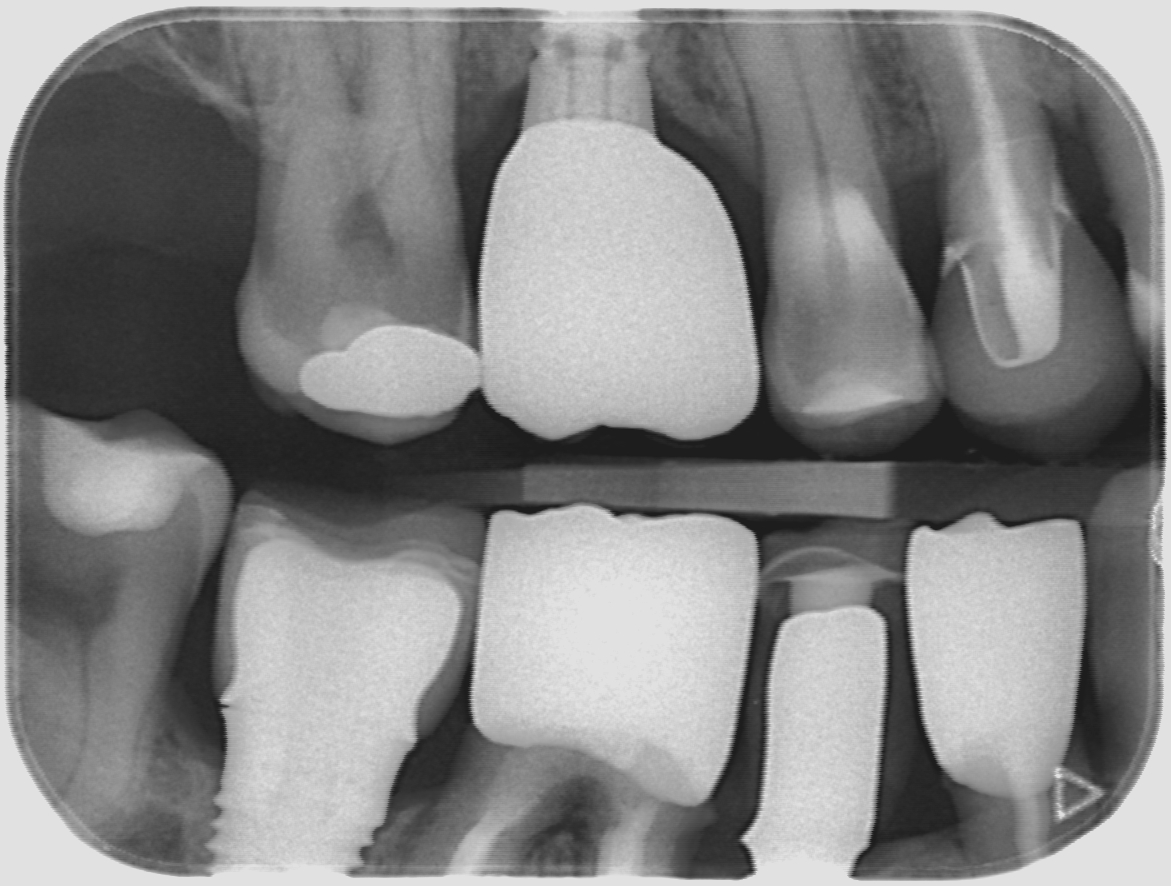 Radiografia bite-wing dei denti