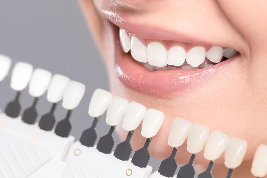 Close-up of a smiling person comparing their teeth to a dental shade guide with varying whiteness levels.