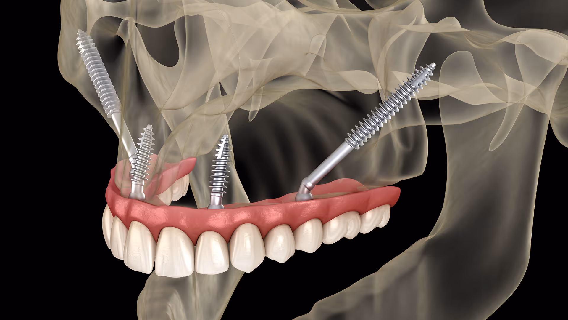 Can You Get Dental Implants If You Have No Bone? Zygomatic Implants Explained