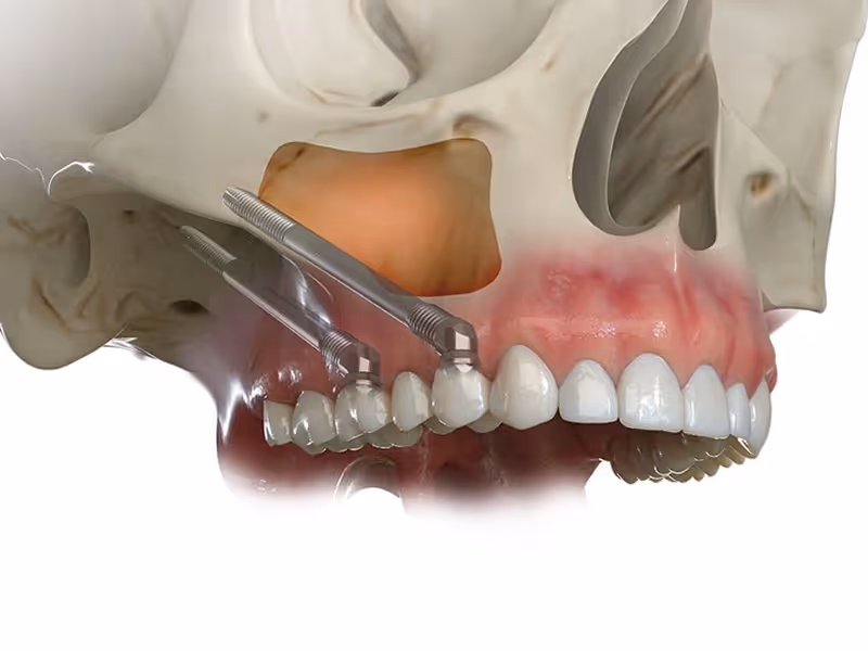 Anatomical diagram showing zygomatic implant placement through the cheekbone for patients with severe upper jaw bone loss at Arvada Dental Center & Implants in Arvada, CO