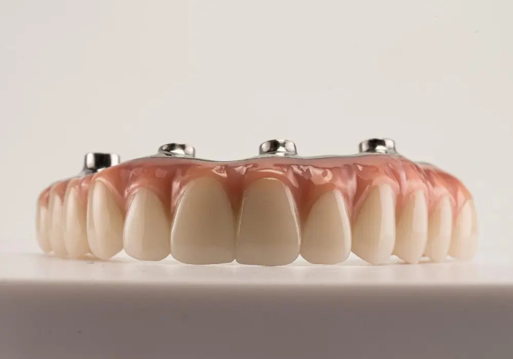 Can Full Mouth Implants Be Done In One Day?