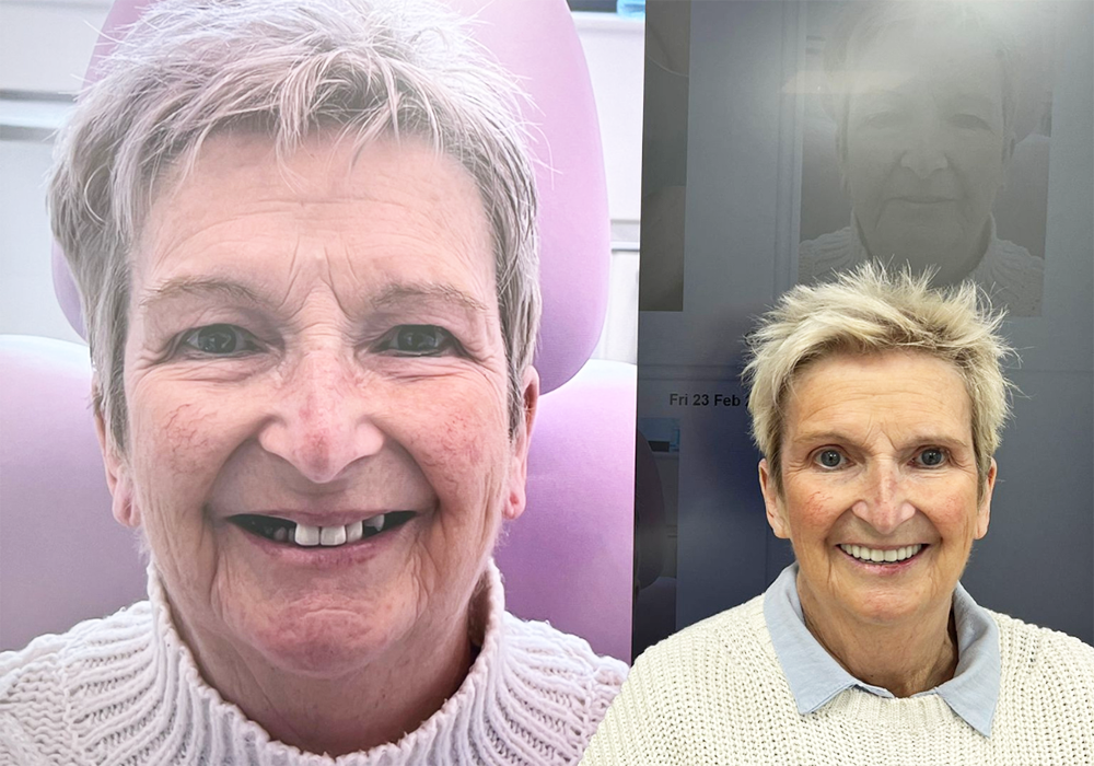 21D Patient Story - Stella