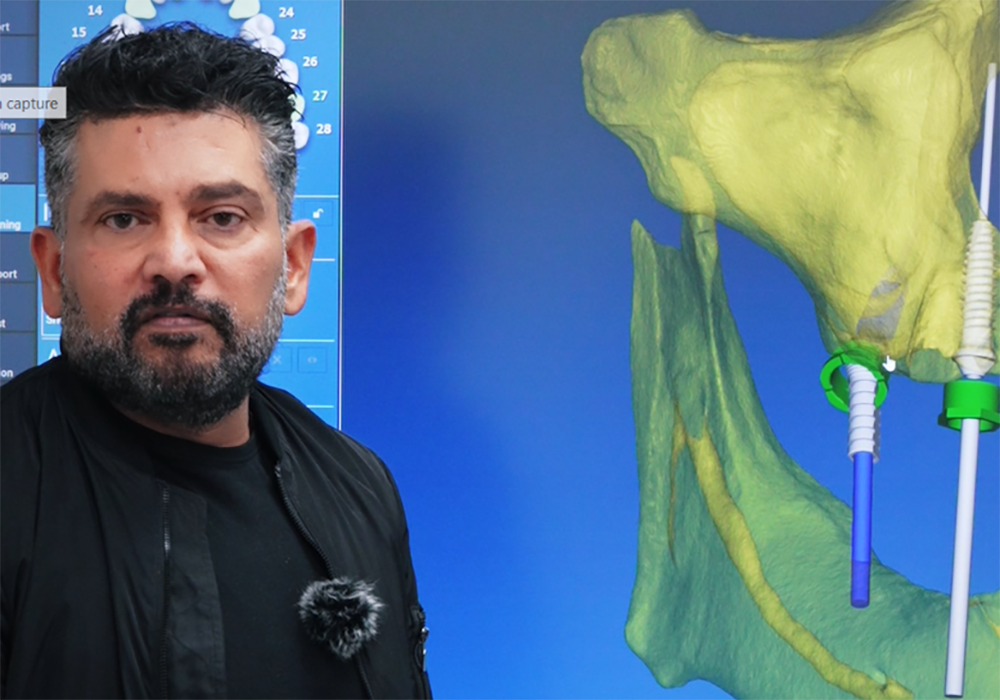 What Is Fully Guided Full-Mouth Implants Surgery?