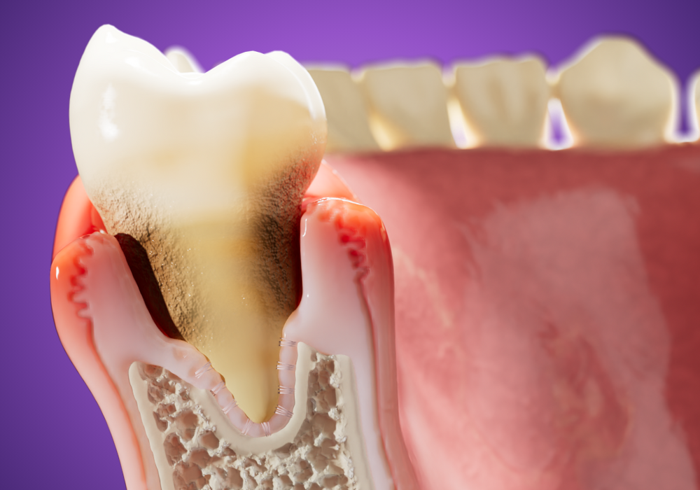 The Progression of Periodontal (Gum) Disease 