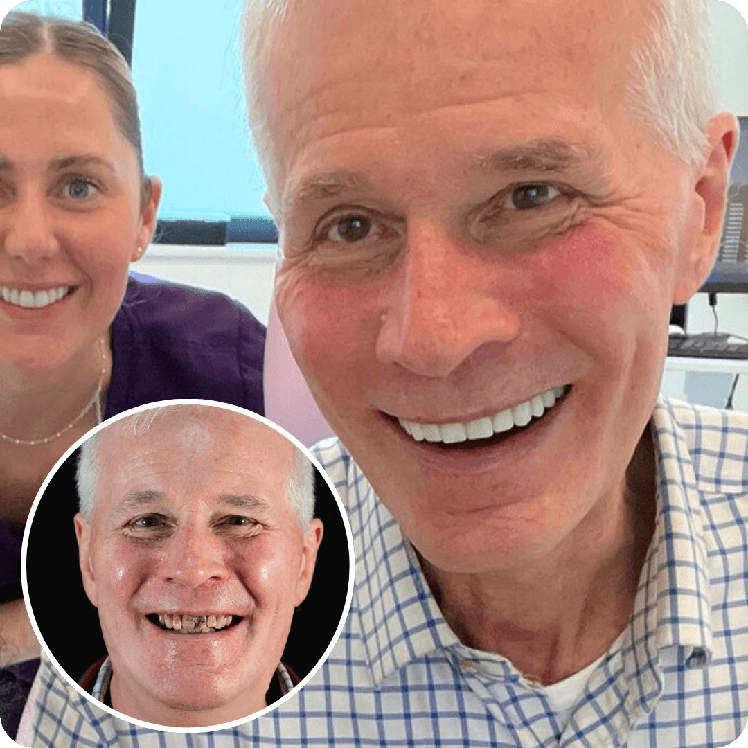 dental implants cost whole mouth