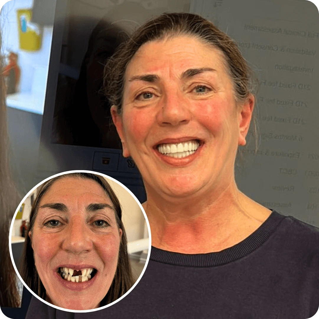 full mouth dental implants