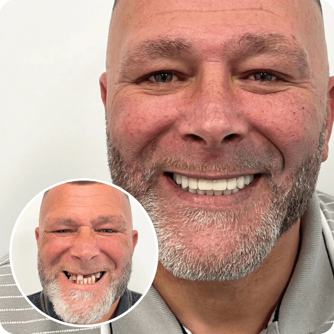 whole mouth dental implants price