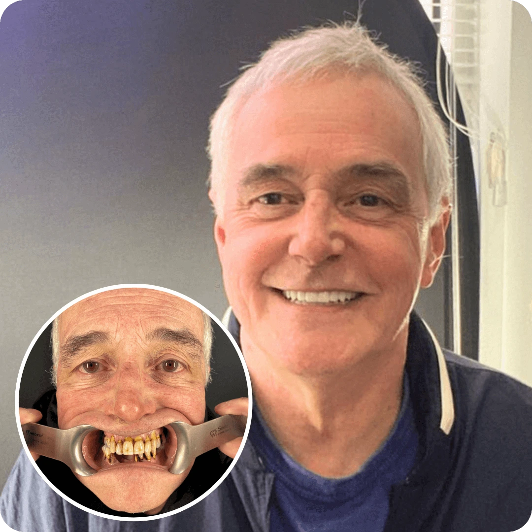 dental implants how much