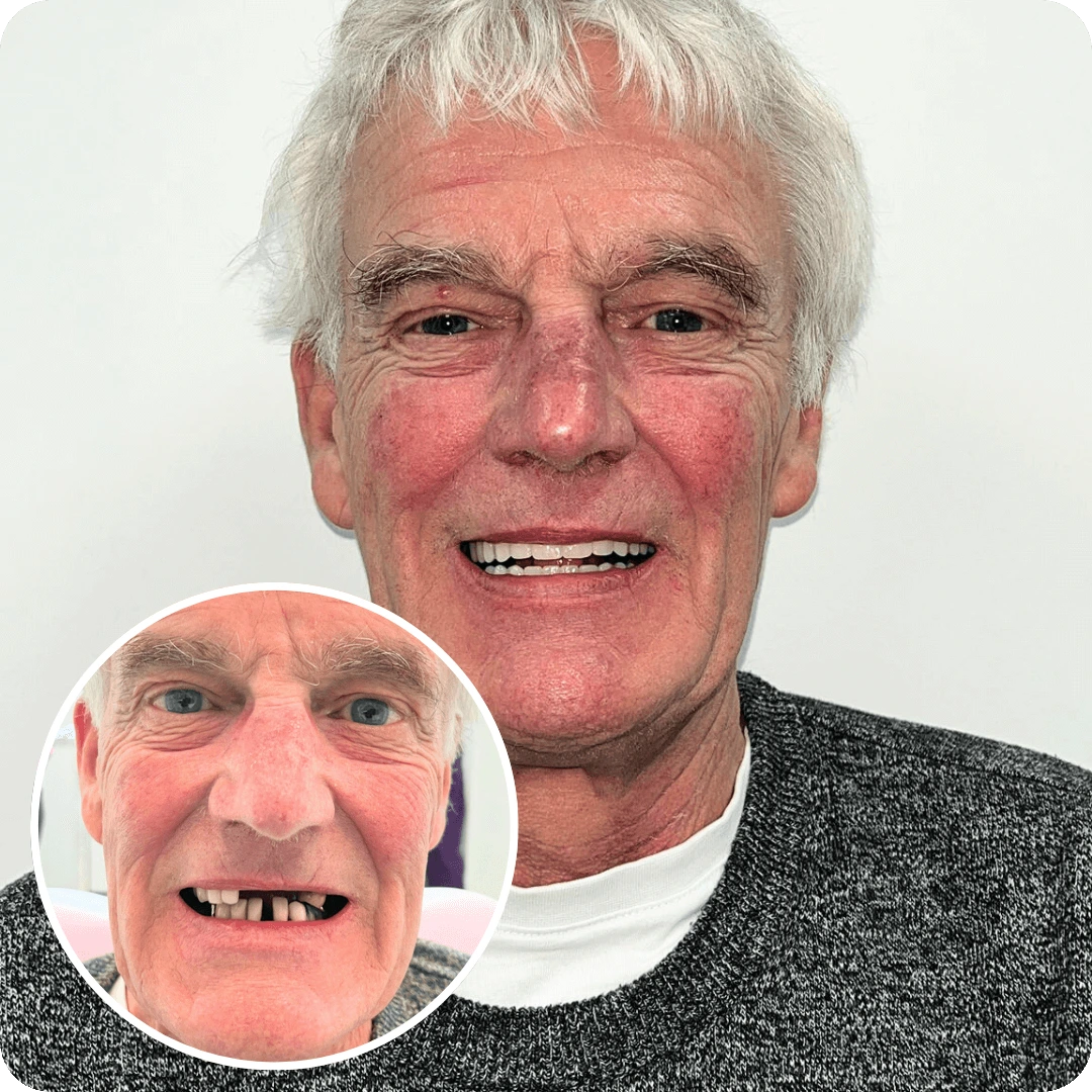 all on 4 dental implants