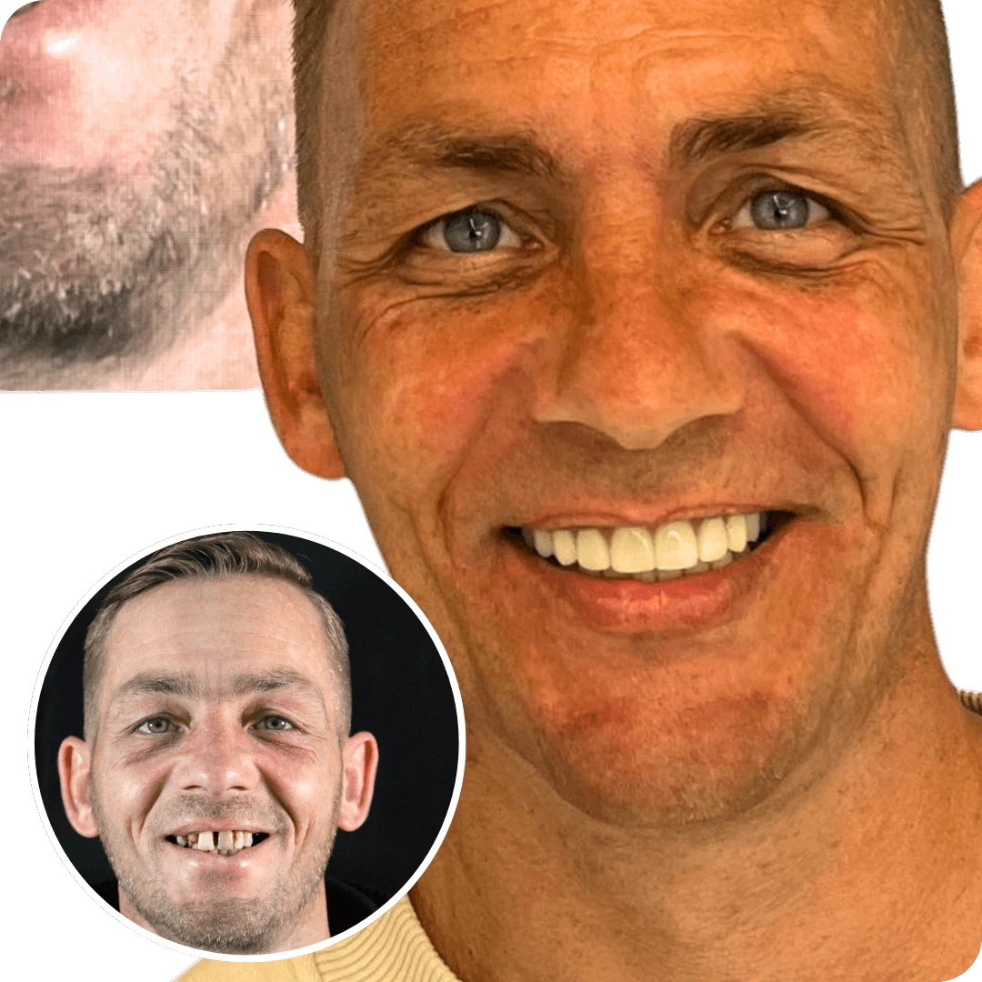 how much dental implants