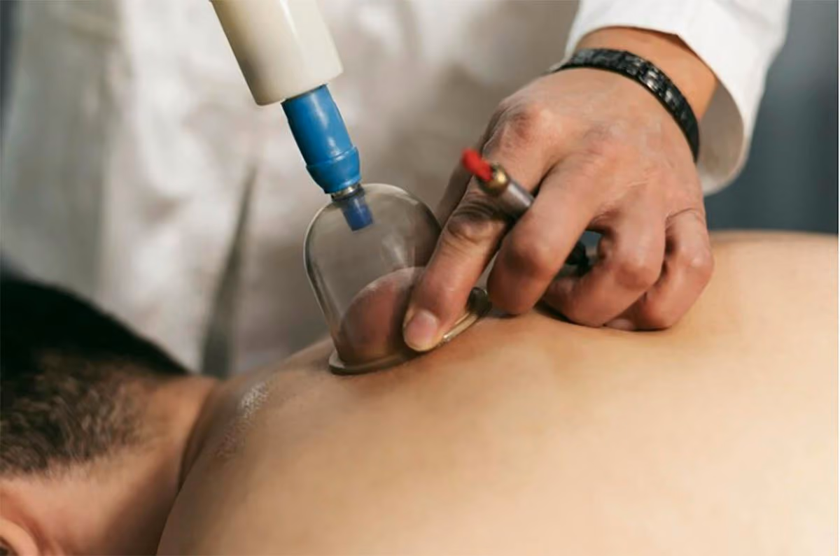 Is Cupping Therapy Safe?