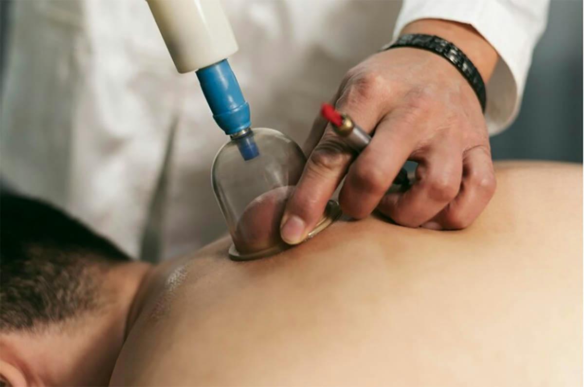 Is Cupping Therapy Safe?