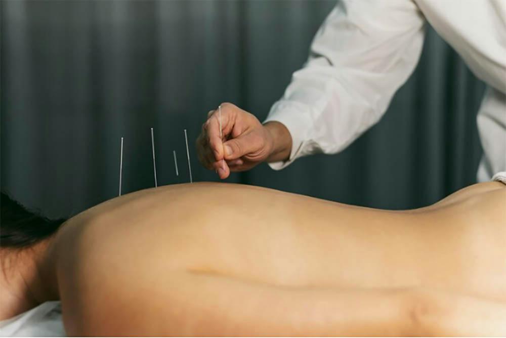 dry needling