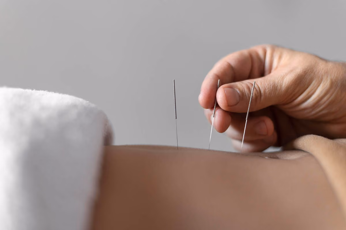 What is Acupuncture?