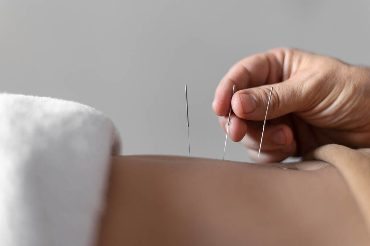 What is Acupuncture?