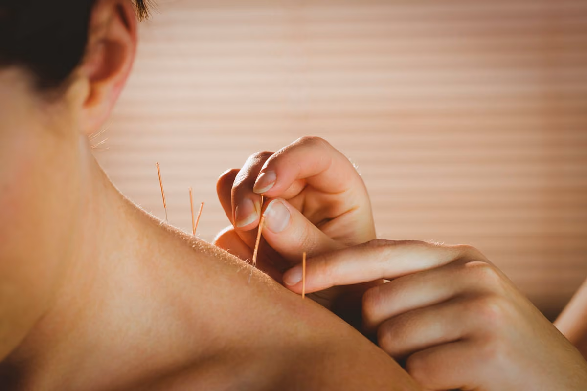 Dry Needling vs. Acupuncture: Which is Better?
