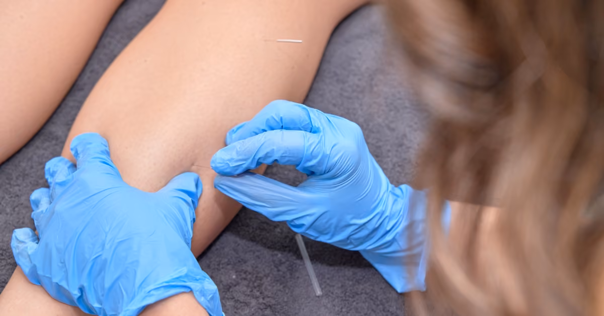 how does dry needling work