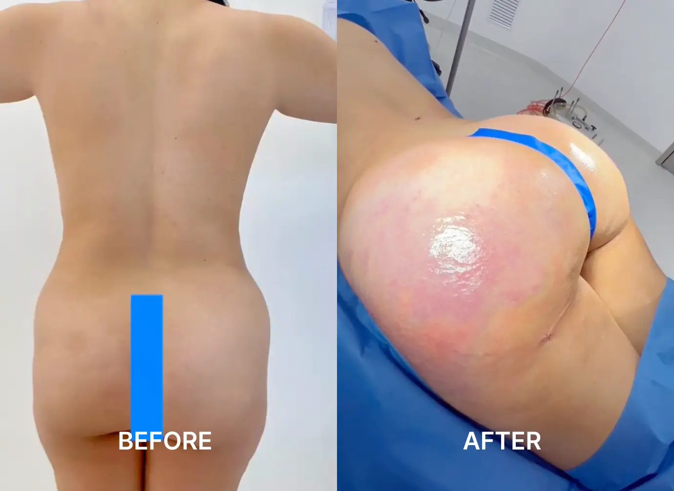 Side-by-side before and after images showing a woman’s buttocks before and after cosmetic enhancement.