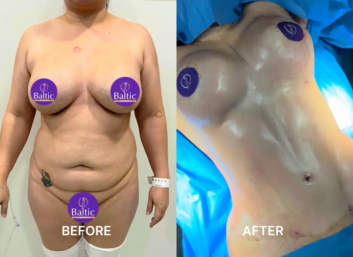 Side-by-side before and after photos of a woman’s body showing significant breast and abdomen contour changes.