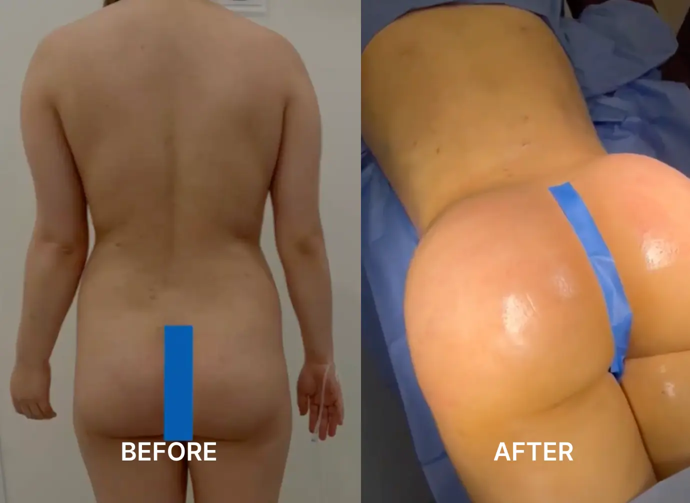 Side-by-side before and after images showing a woman's buttocks, before flat and after enhanced and larger.
