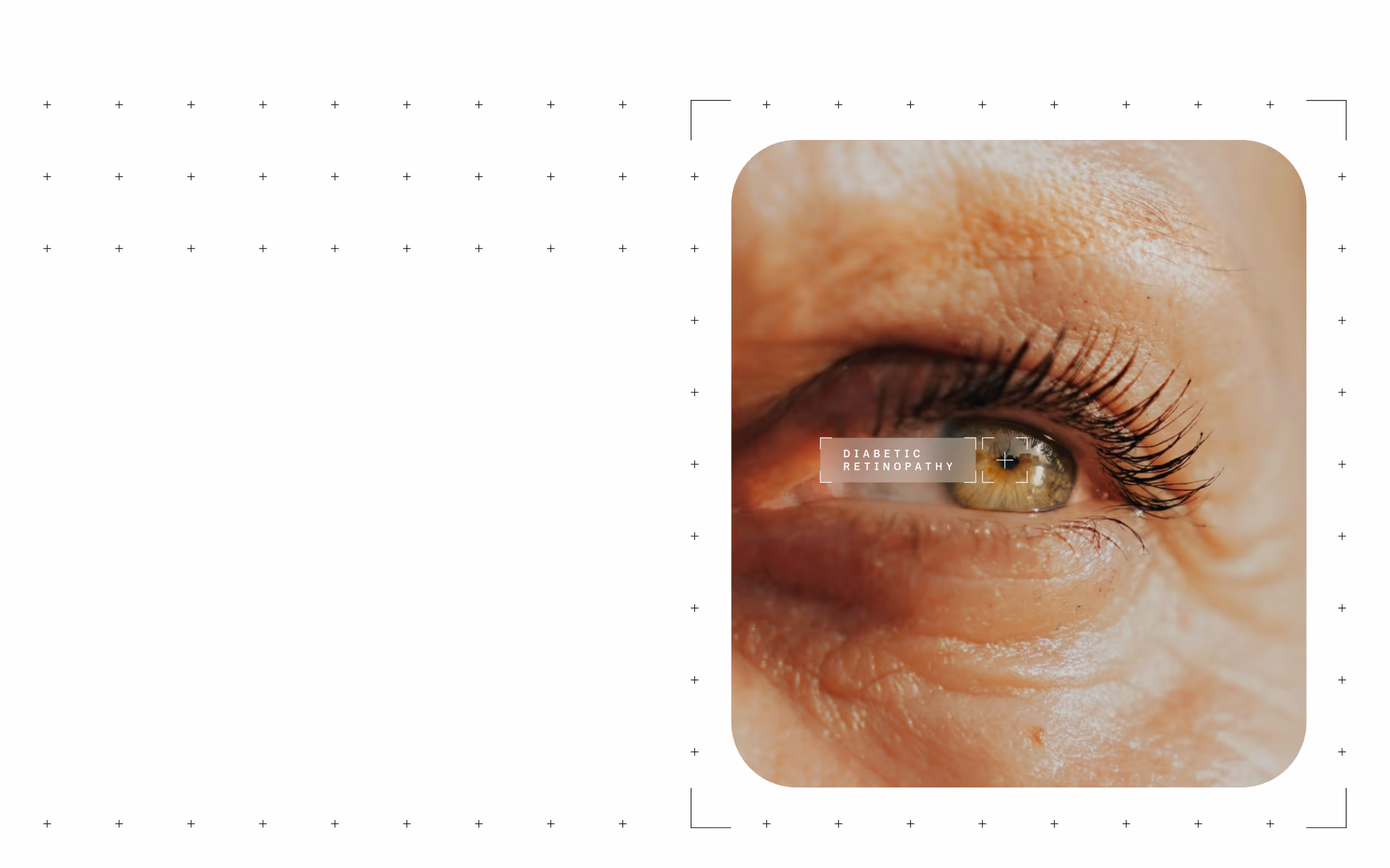 Close-up of an elderly person's eye with text overlay reading diabetic retinopathy.