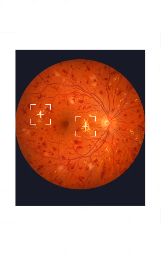 Close-up of a retina with highlighted areas showing retinal damage or abnormalities.