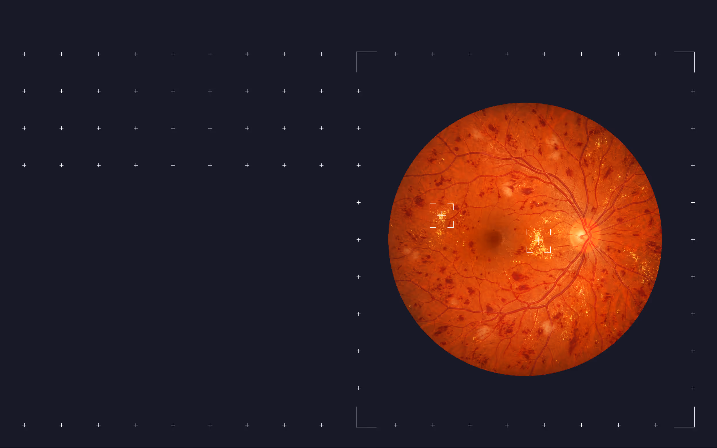 Close-up of a retina with highlighted areas showing retinal damage or abnormalities.