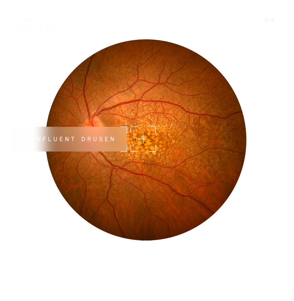 Fundus photo showing retina affected by suspected intermediate AMD with visible confluent drusen.