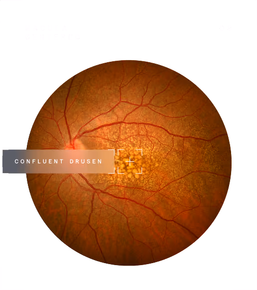 Fundus photo showing retina affected by suspected intermediate AMD with visible confluent drusen.