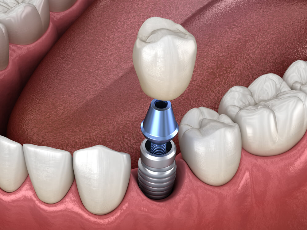 Illustration of a dental implant