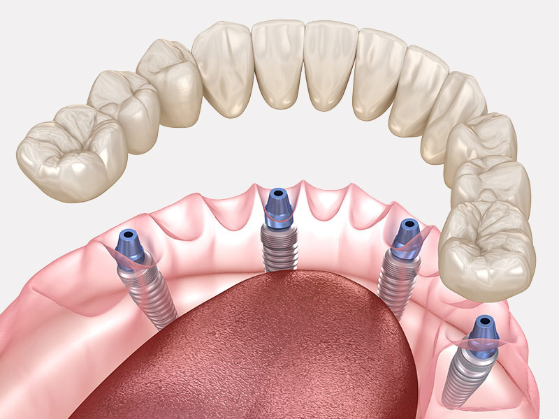 Dental illustration showing four dental implants fitted into the lower jaw with a full arch of prosthetic teeth above.