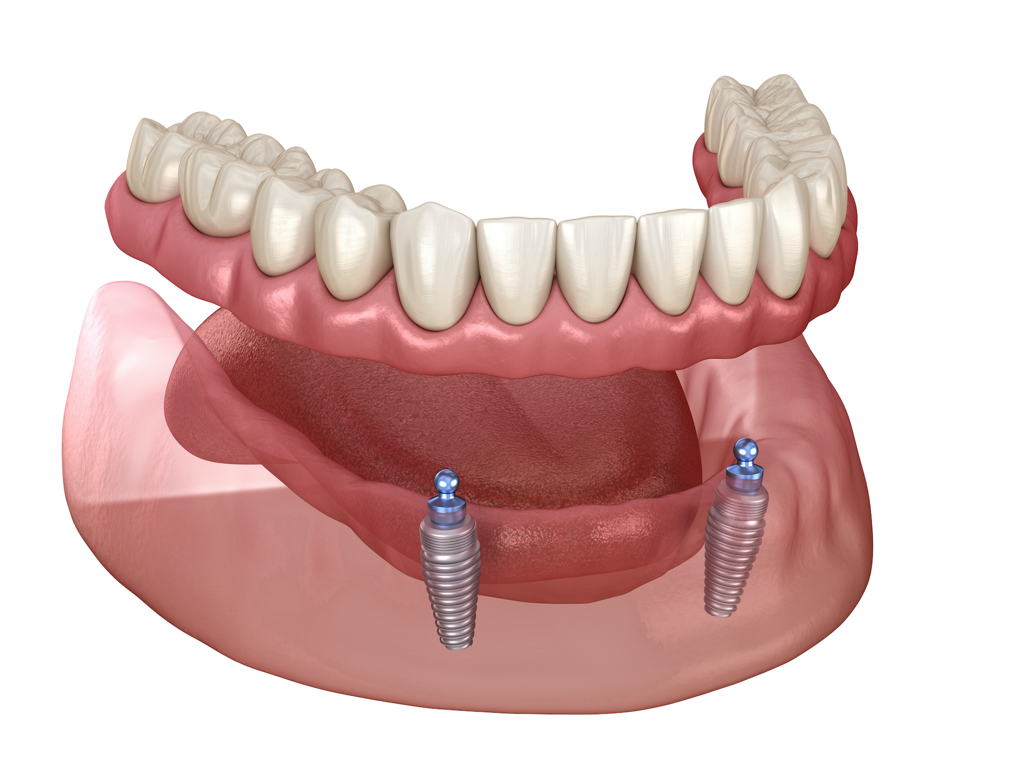 Illustration showing a lower denture attached to two dental implants in the lower jaw.