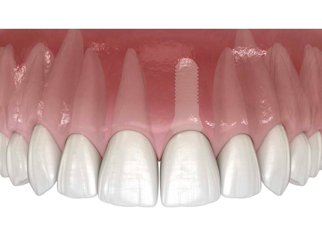 Dental illustration showing a ceramic implant screw placed in the upper jaw among natural teeth.