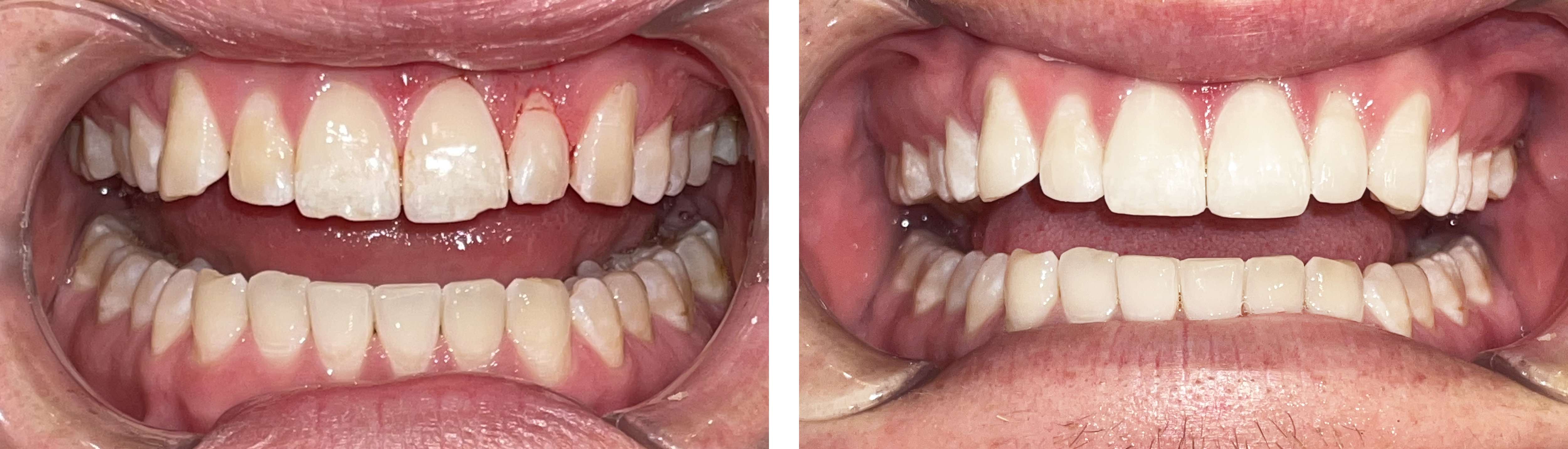 Side-by-side close-up of person's teeth before and after dental treatment showing improved alignment and whitening. porcelain veneer results Santa Barbara CA patient before after.