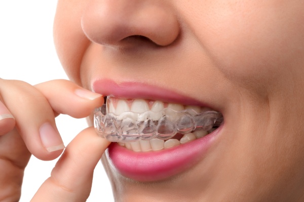 Close-up of a person inserting a clear dental aligner over their teeth.