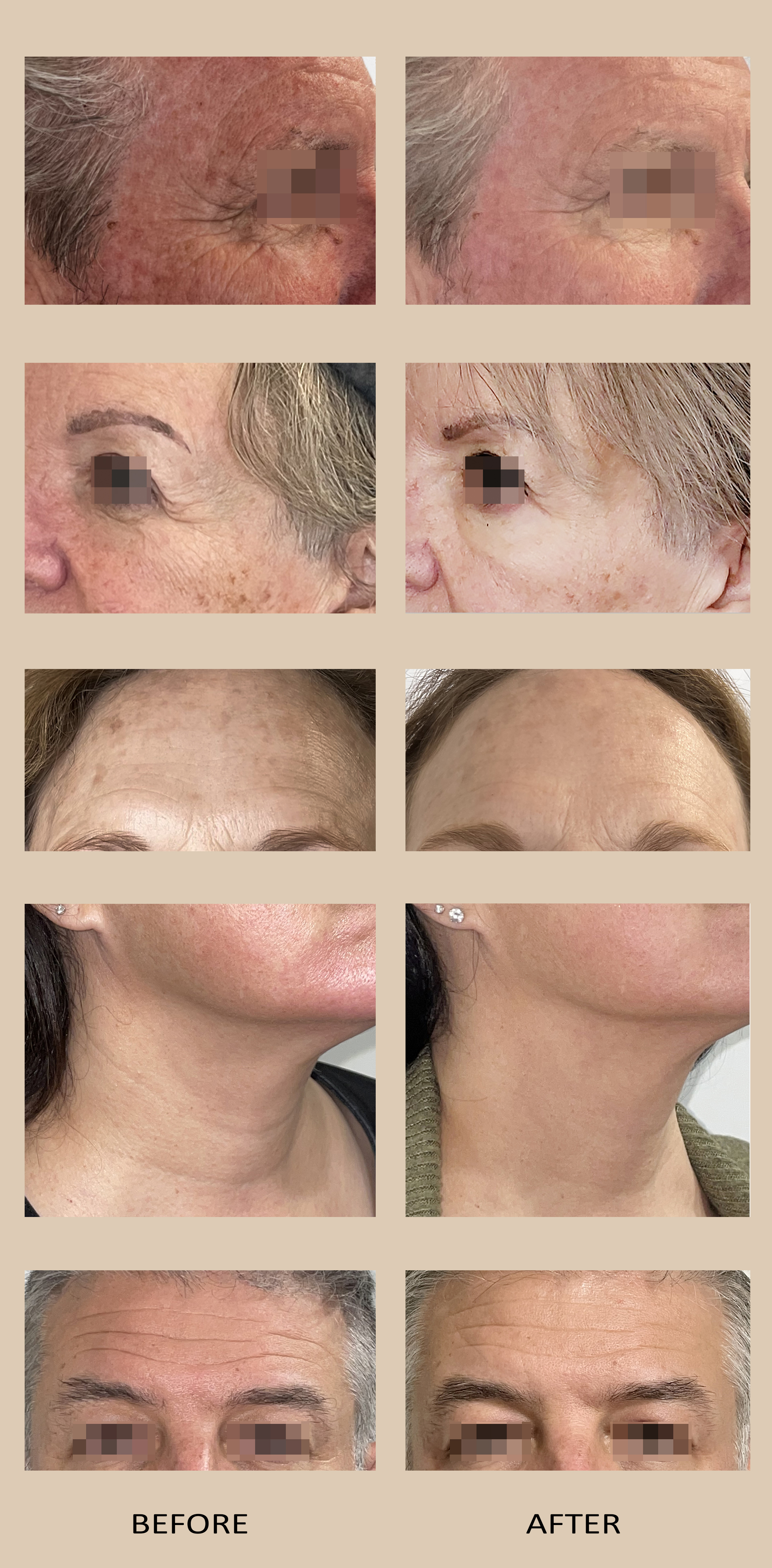 Before and after images showing reduced wrinkles, improved skin texture, and less pigmentation on different face areas of men and women.