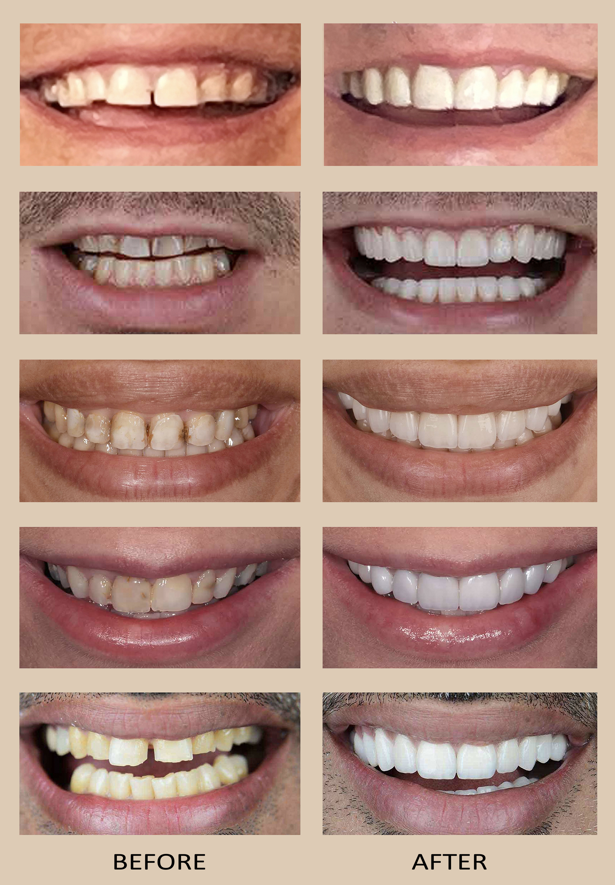 Comparison of five sets of teeth before and after dental veneers, showing significant improvement in color, alignment, and appearance.