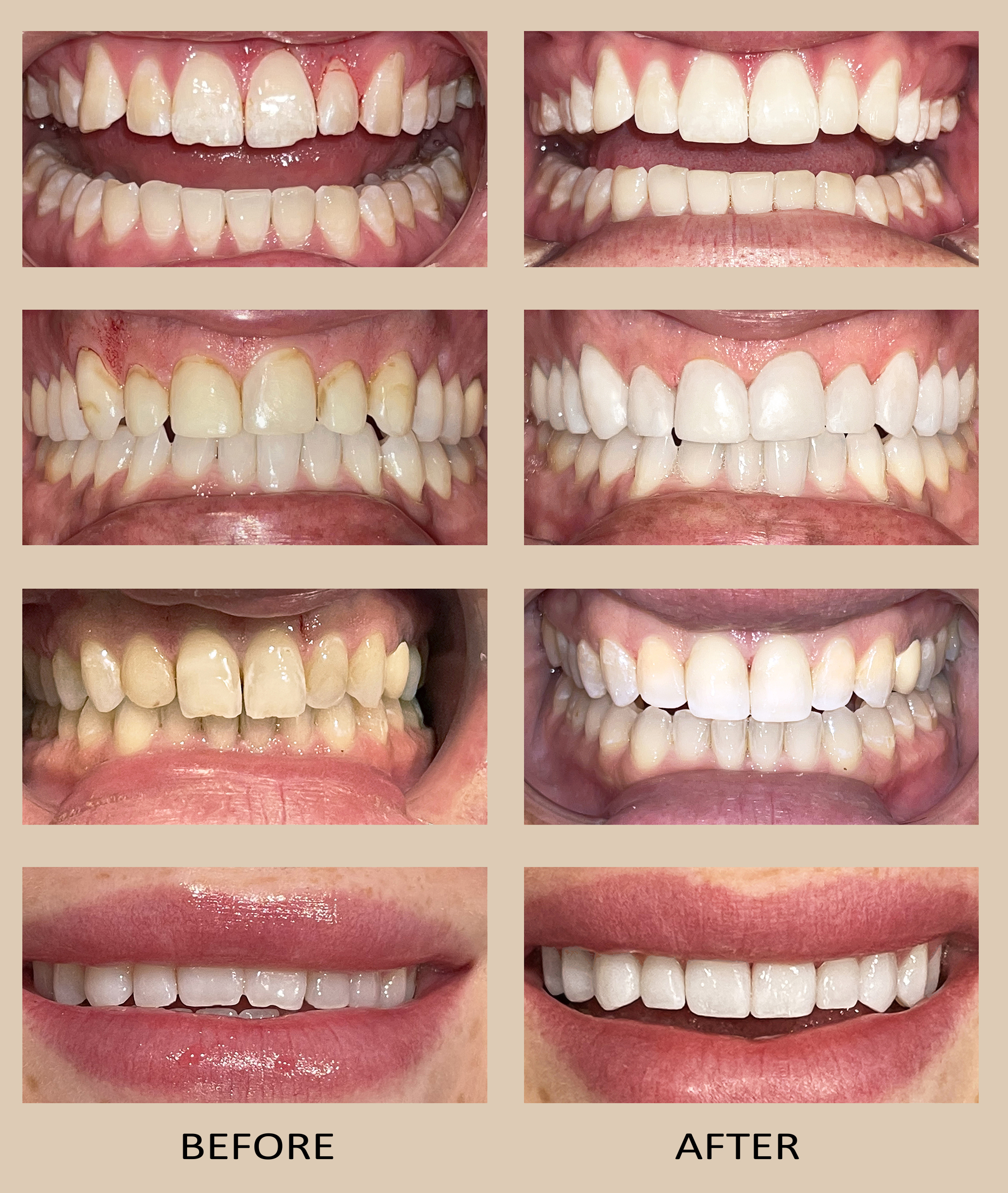 Four sets of before and after close-up photos showing dental bonding improvements, highlighting whiter, more aligned teeth and repaired gaps.